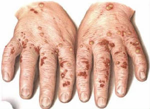 scabies.jpg